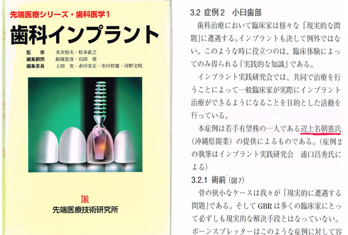 歯科インプラント