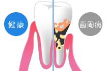 歯周病の治療